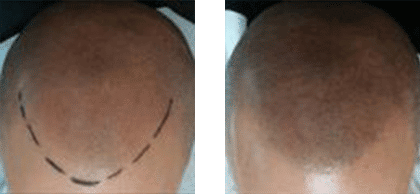Smp Scalp Micropigmentation Sydney The Crown Clinic