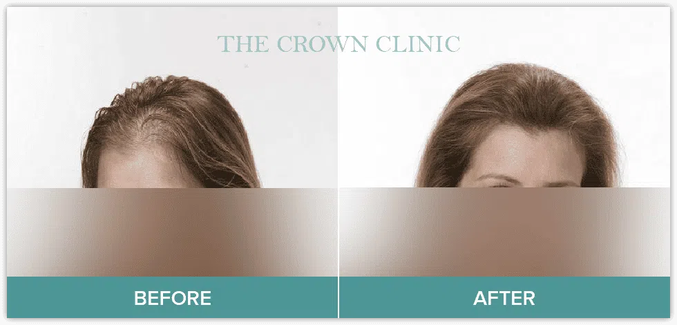 female hair loss treatment sydney