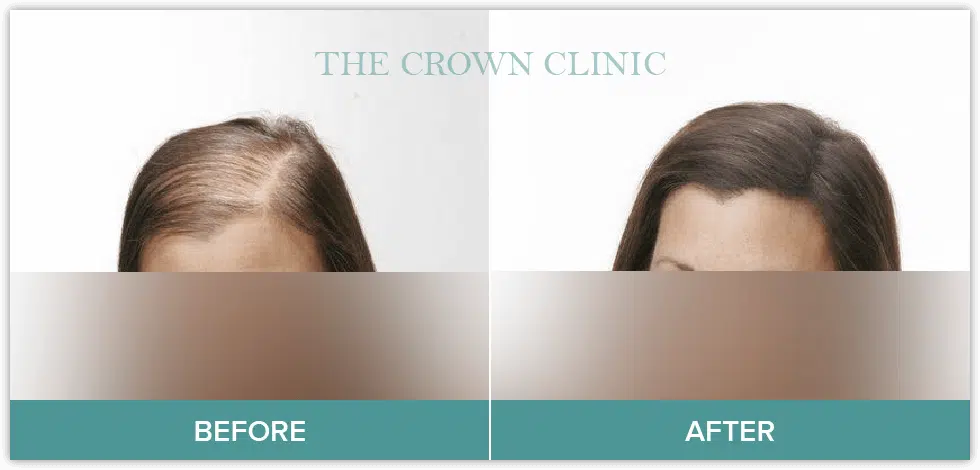 female hair loss treatment