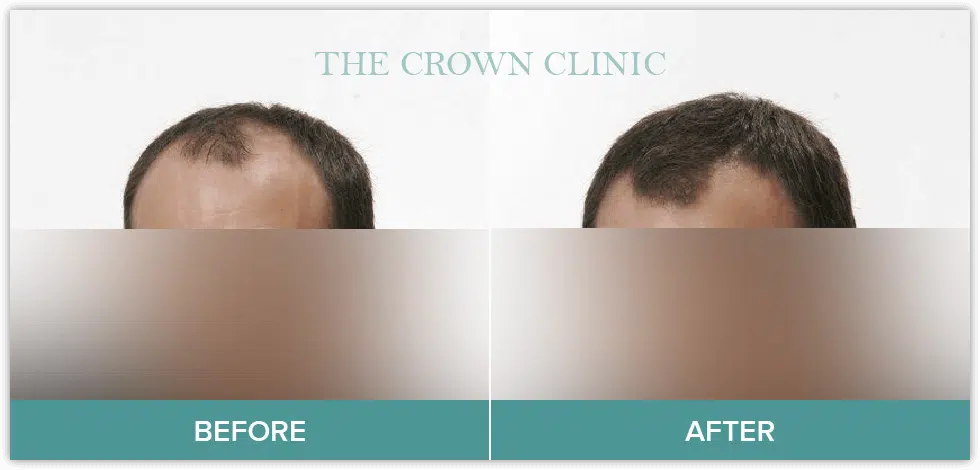 hair loss treament for men