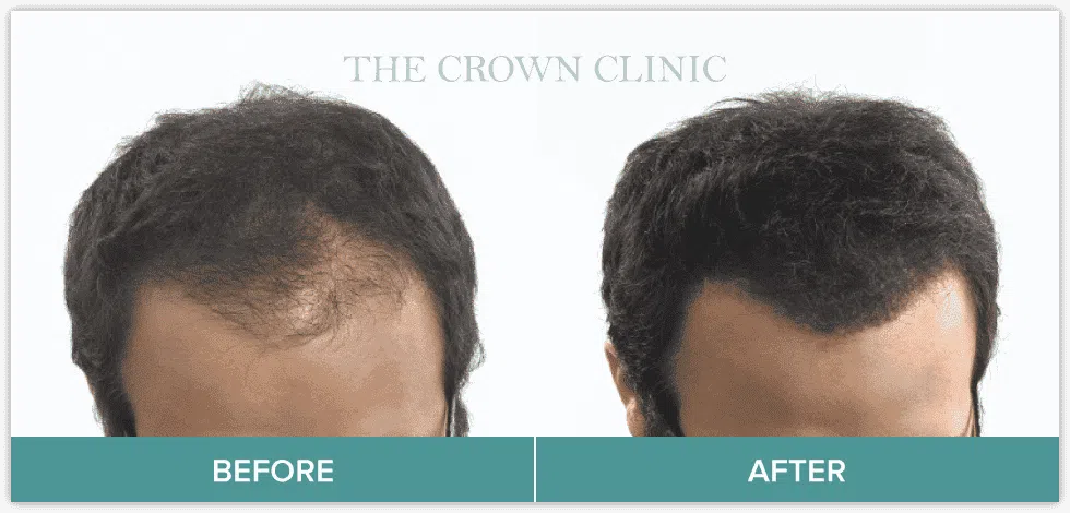 hair loss treament for men
