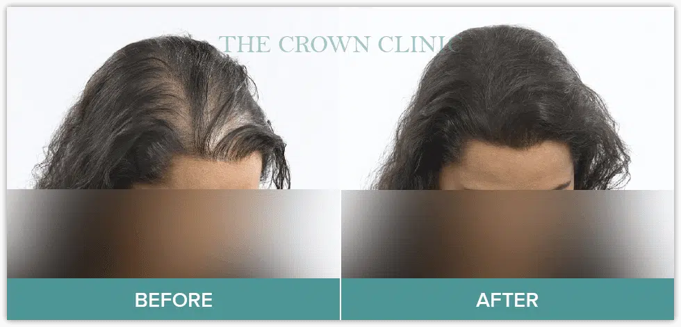 hair loss treament for women