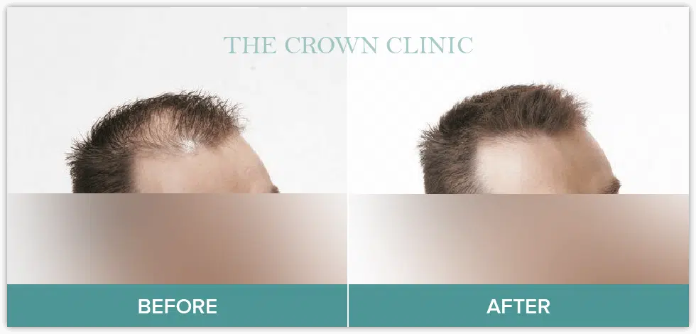 hair loss treatment sydney