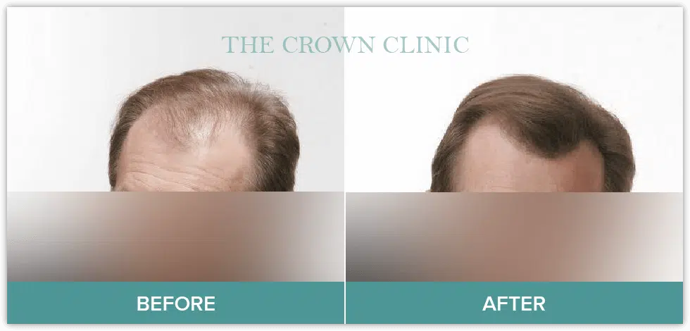 hair loss treament