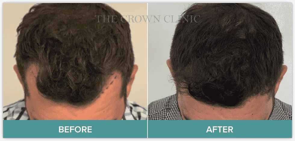 FUE Transplant | Crown Clinic
