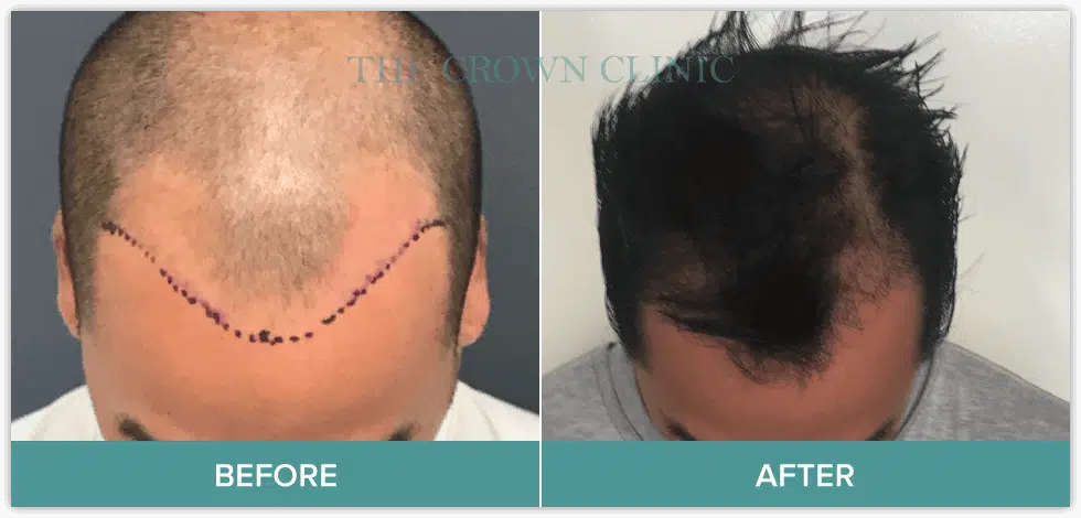Fue Hair Transplant Results Crown Clinic