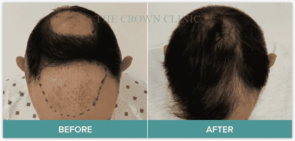Hair Transplant Surgery Melbourne - Crown Clinic