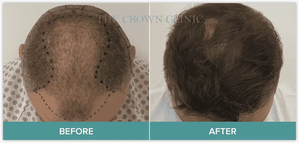 Hair Loss Treatment Melbourne - Crown Clinic