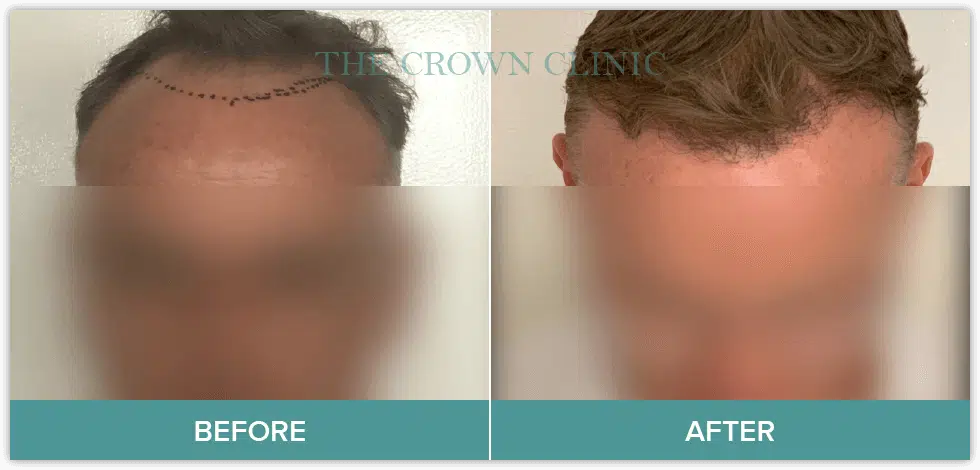 FUE Hair Transplantation | Crown Clinic