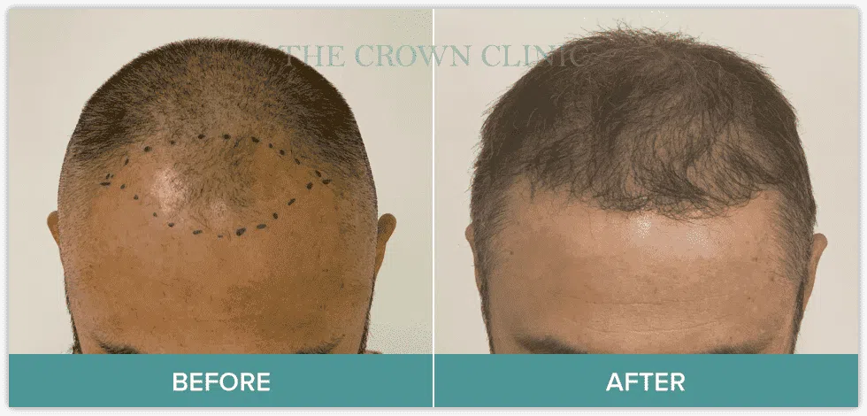FUE Hair Transplantation | Crown Clinic