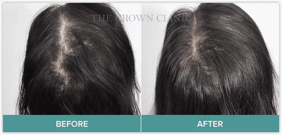 SMP Treatment Results - Scalp Micropigmentation - Crown Clinic