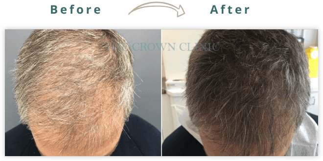scalp pigmentation treatment sydney
