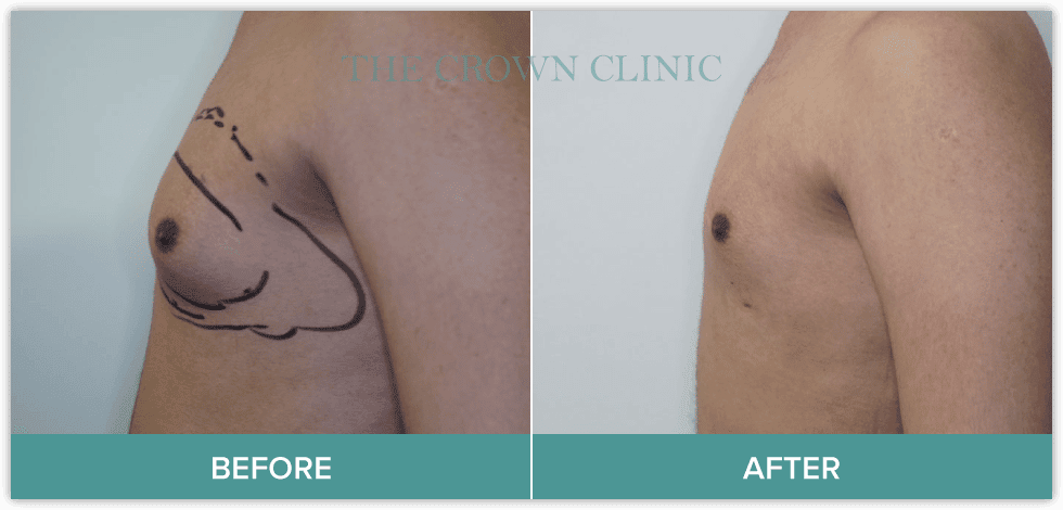 gynaecomastia-surgery-in-sydney.png