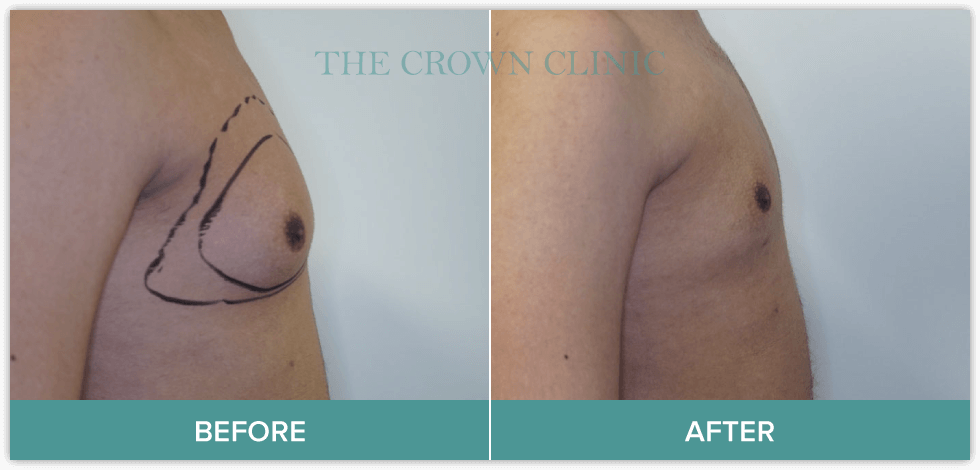 gynaecomastia-treatment-in-sydney.png