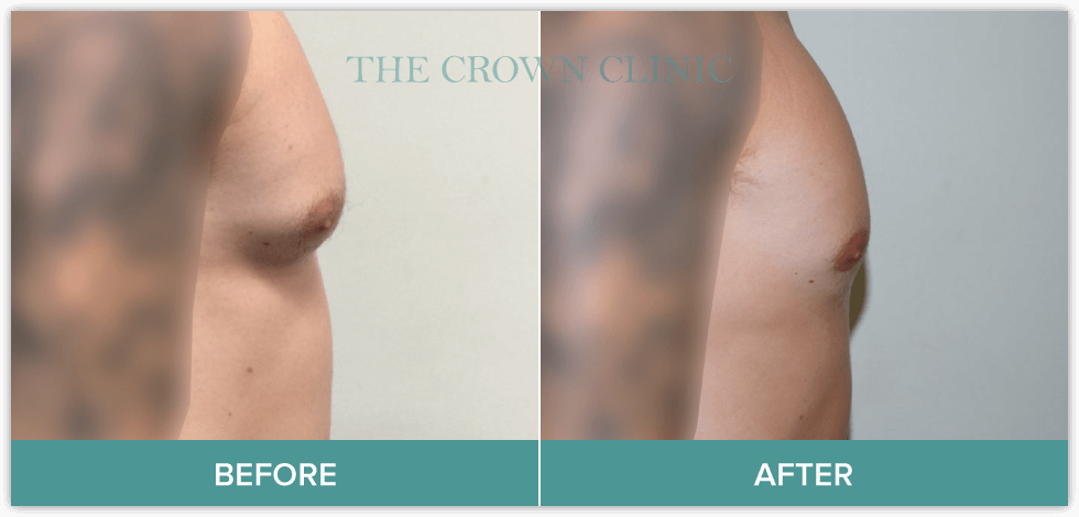 gynaecomastia-treatment.png