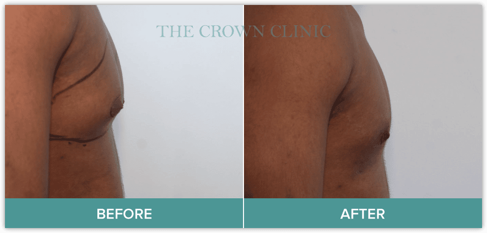 gynecomastia-surgery-sydney.png