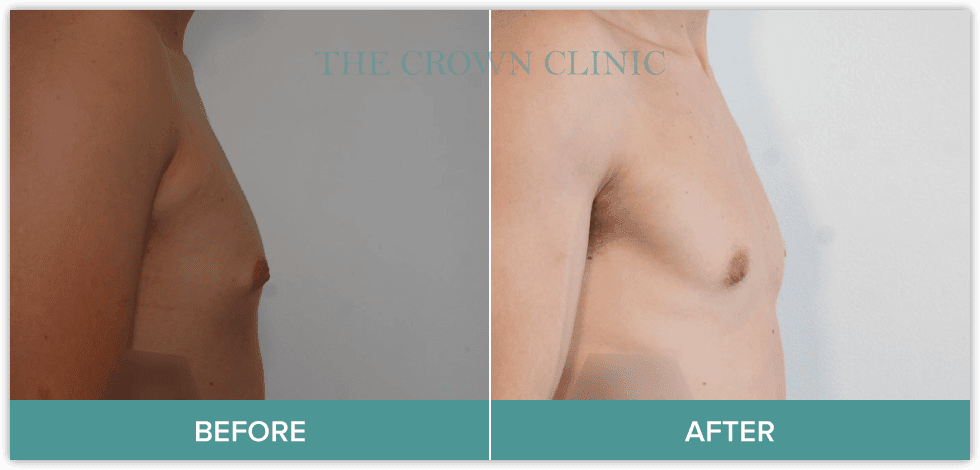 gynecomastia-treatment-sydney.png