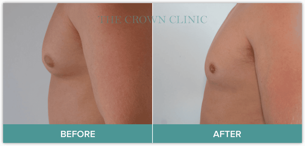 male-breast-reduction-surgery-before-after.png