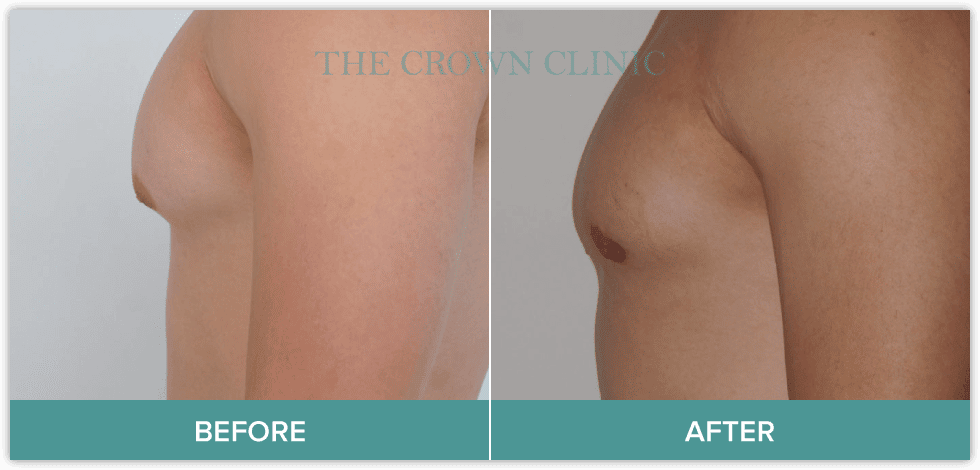 male-breast-reduction-surgery-in-sydney.png
