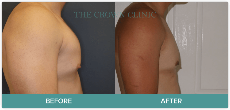 male-breast-reduction-surgery.png