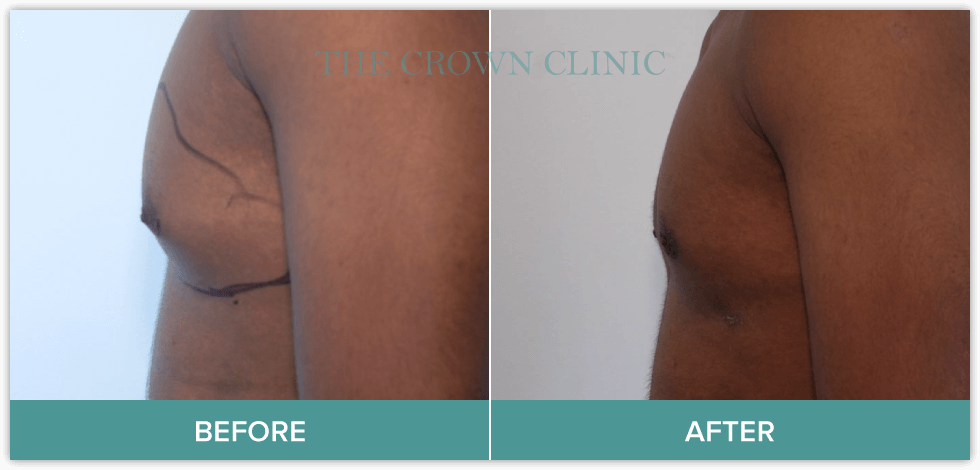 male-breast-reduction-sydney.png