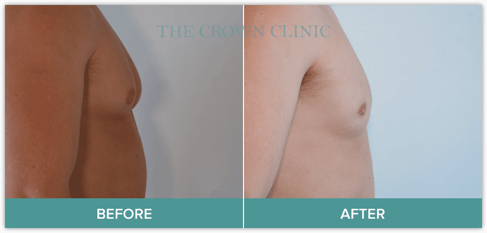 male-breast-reduction-treatment-in-sydney.png