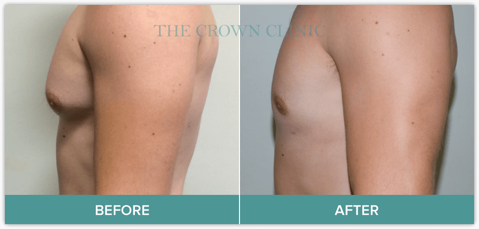 male-breast-reduction-treatment.png