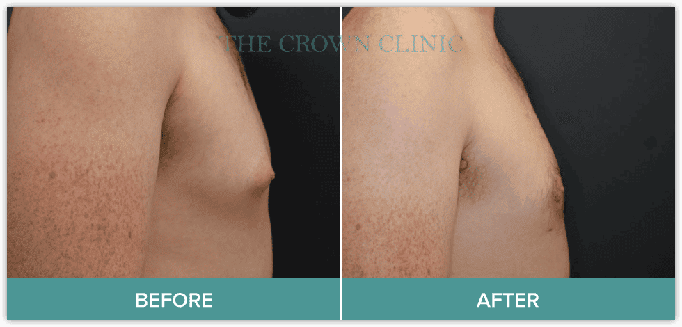 male-breast-reduction.png