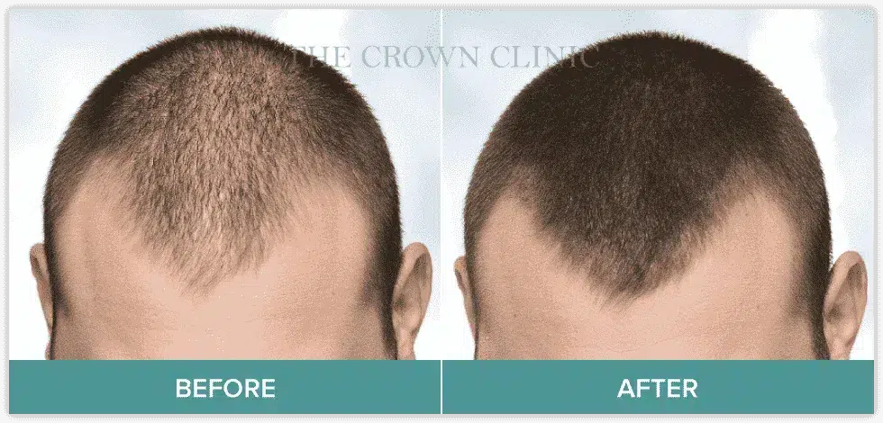 best-hair-loss-treatment-for-men-sydney