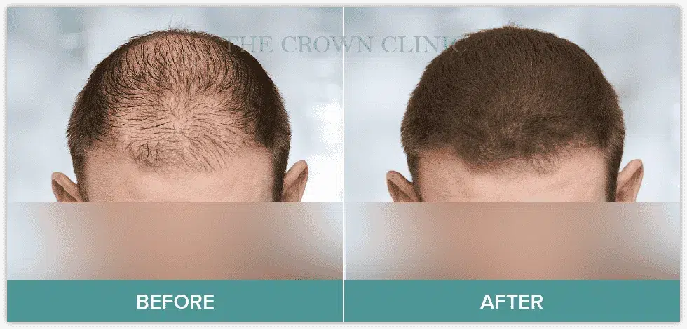 best-hair-loss-treatment-for-men