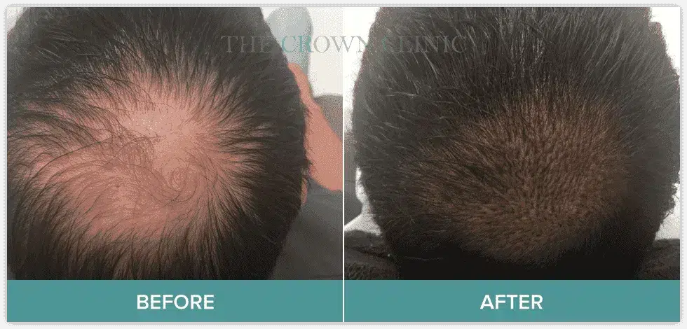 hair-micropigmentation