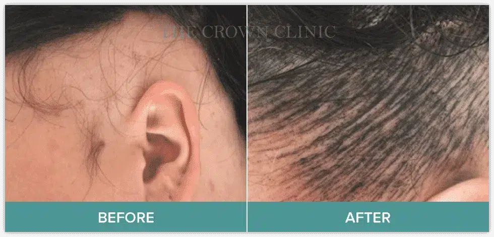 scalp-micropigmentation-for-female