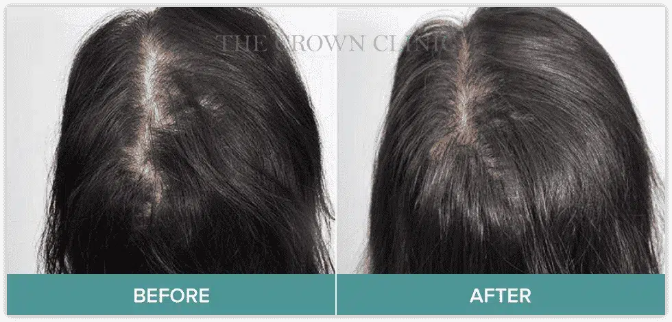 scalp-micropigmentation-for-women