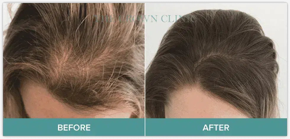 scalp-micropigmentation-in-sydney