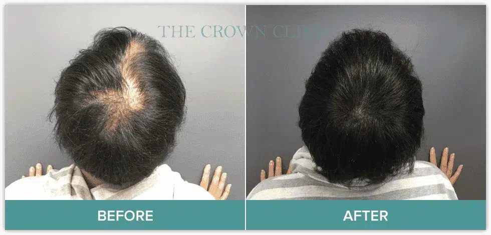 scalp-micropigmentation-sydney