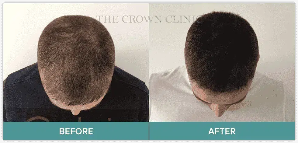 scalp-micropigmentation
