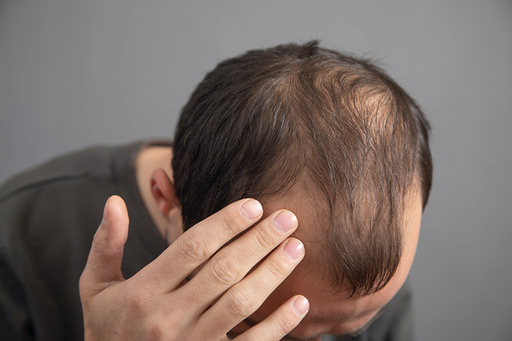 Does Diabetes Cause Hair Loss | Diabetes and Hair Loss | Can Diabetes Cause Hair Loss