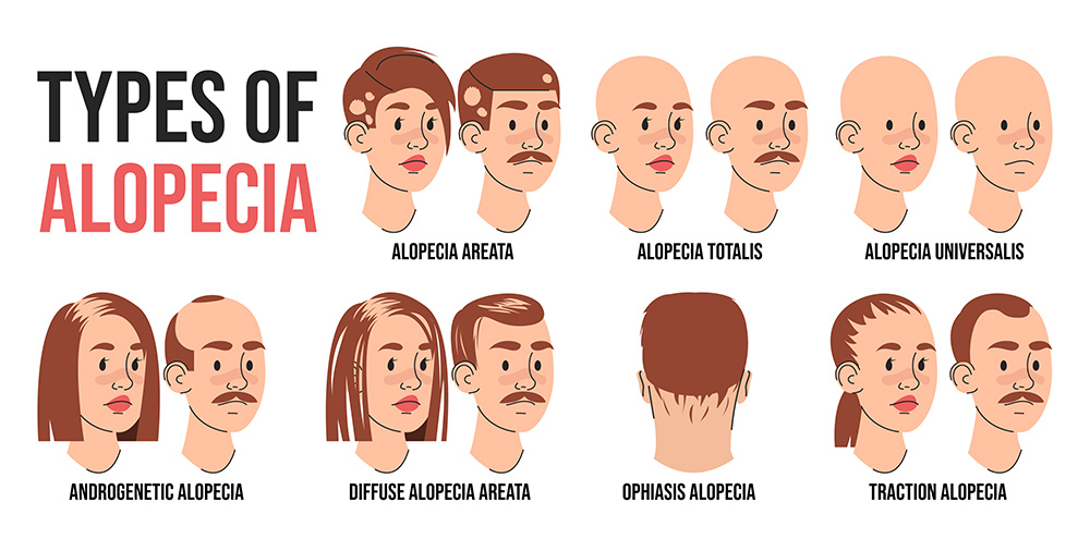 Types of Hair Loss | Kinds of Hair Loss | Different Types of Hair Loss