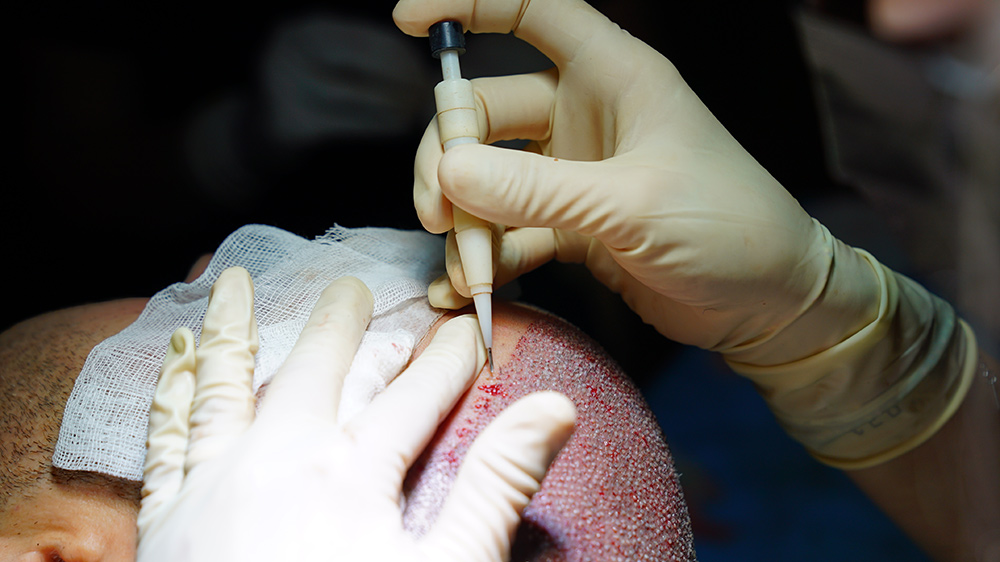 DHI vs FUE | DHI vs FUE Hair Transplant | What is DHI Hair Transplant | Differences Between DHI and FUE
