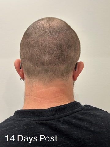 jacob-14-days-post