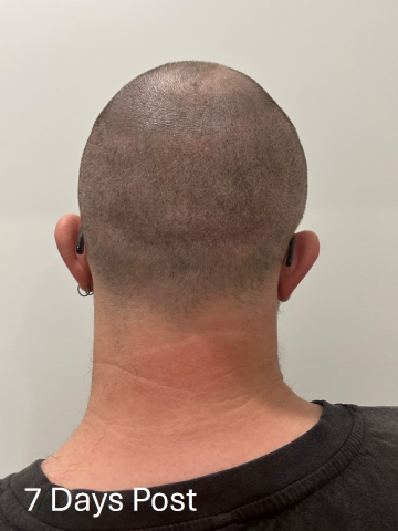 jacob-7-days-post
