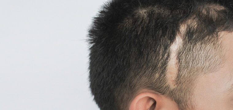 Hair Transplant on Scar | Hair Transplant Scar | Can Hair Grow on Scars