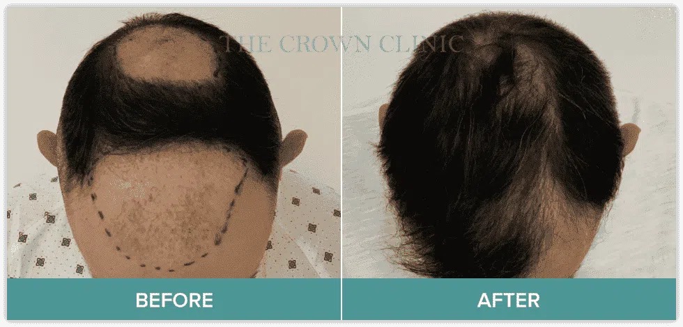 Hair Transplant on Scar | Hair Transplant Scar | Can Hair Grow on Scars