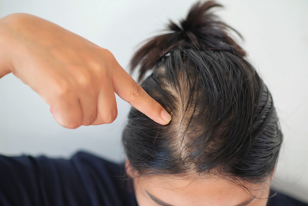 Stages of Hair Growth | Hair Growth Cycle | Catagen Phase of Hair Growth