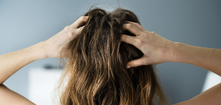 Itchy Scalp and Hair Loss | Itchy Scalp Causes | How to Stop Itchy Scalp